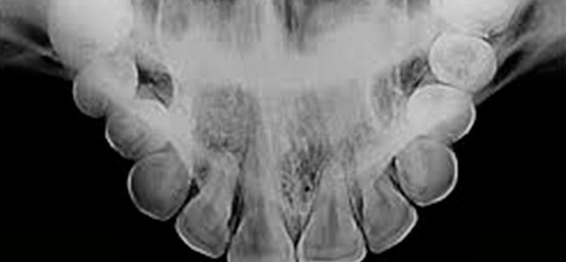 Oclusal 