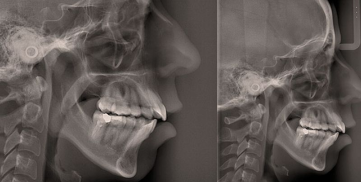 Análise Idade Óssea Coluna Cervical