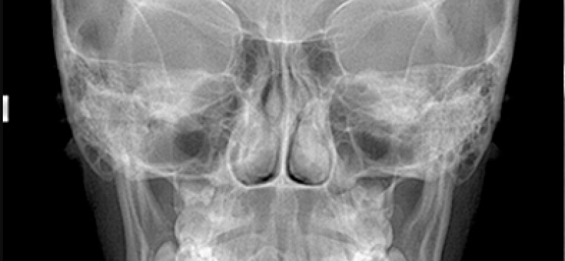 Póstero Anterior Frontal ou Telerradiografia Frontal Digital