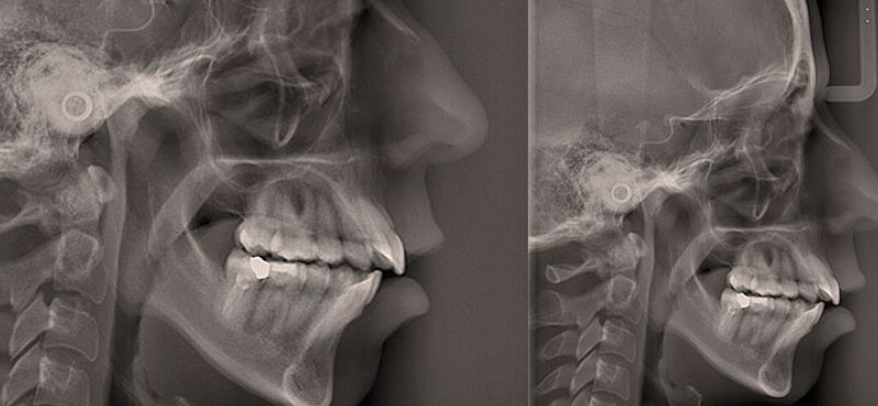 Análise Idade Óssea Coluna Cervical